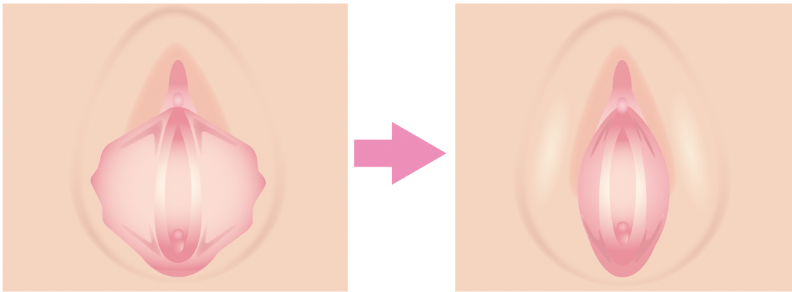 小陰唇縮小の効果について
